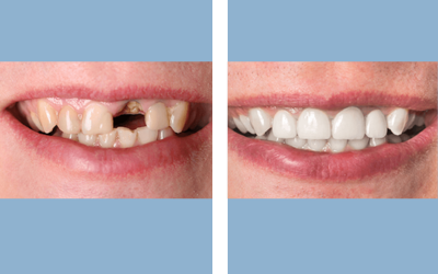 Before and After